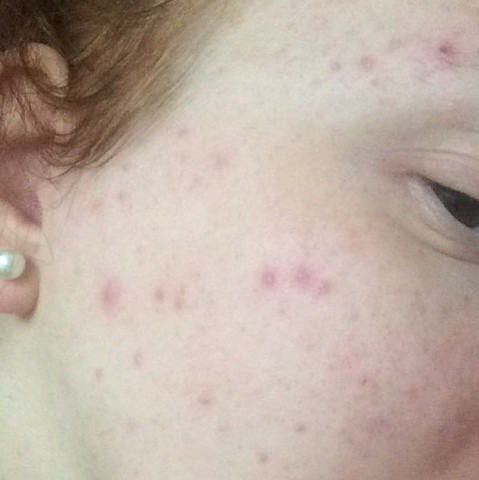 Ist Das Der Anfang Von Akne Haut Ist Das Der Anfang Von Akne Haut