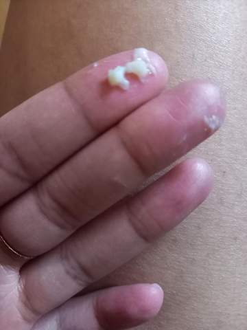 Ist Das Der Schleimpropf Bild 35 Ssw Schwangerschaft Ist Das Der Schleimpropf Bild 35 Ssw Schwangerschaft