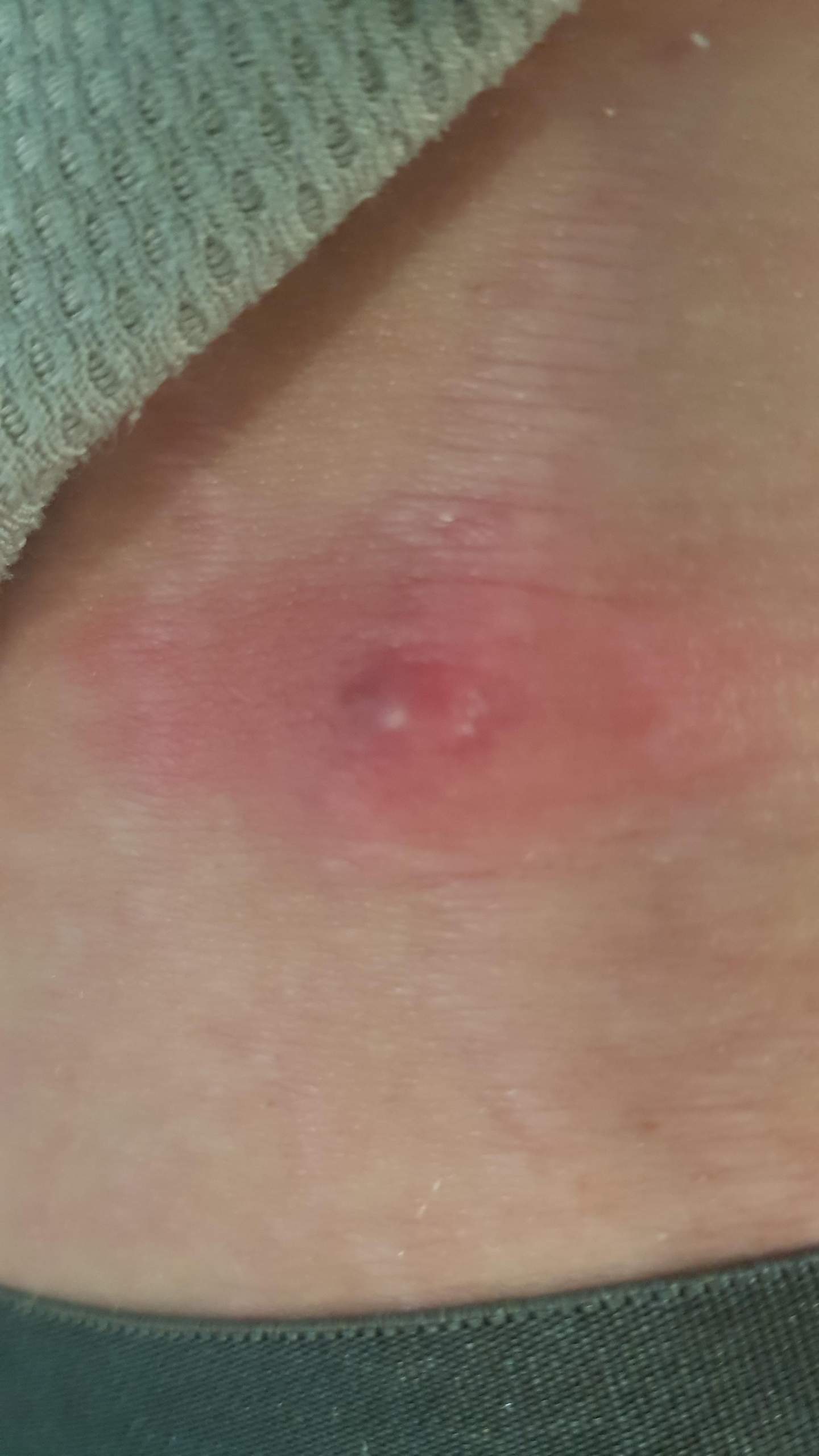 Ist das ein Abszess? Darf ich trainieren? (Gesundheit, Medizin, Krankheit)