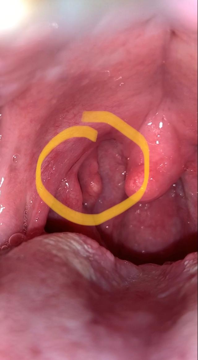 Ist das ein Abszess hinter der Mandel? (hno-arzt)