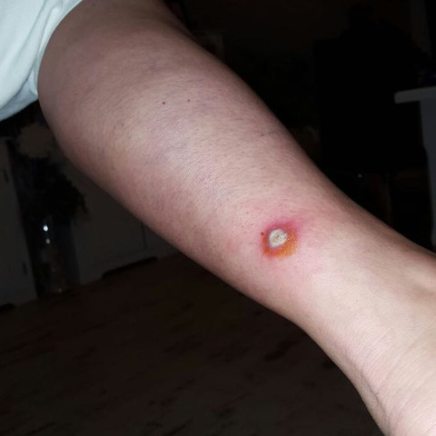 Ist Das Ein Abszess Oder Etwas Anderes Beine Ist Das Ein Abszess Oder Etwas Anderes Beine