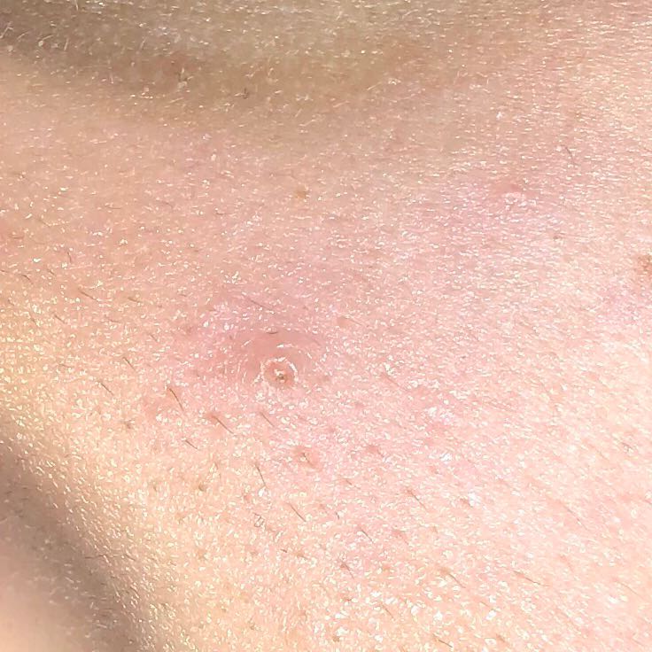 ist das ein atherom? ein gewöhnlicher pickel ist es nicht oder? ich konnte ihn nicht ausdrücken ist das ein atherom? ein gewöhnlicher pickel ist es nicht oder? ich konnte ihn nicht ausdrücken