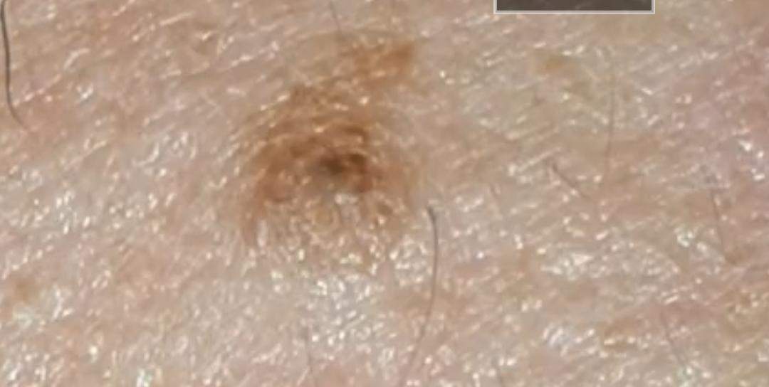 Ist das ein auffälliges Muttermal oder normal? (Hautarzt)