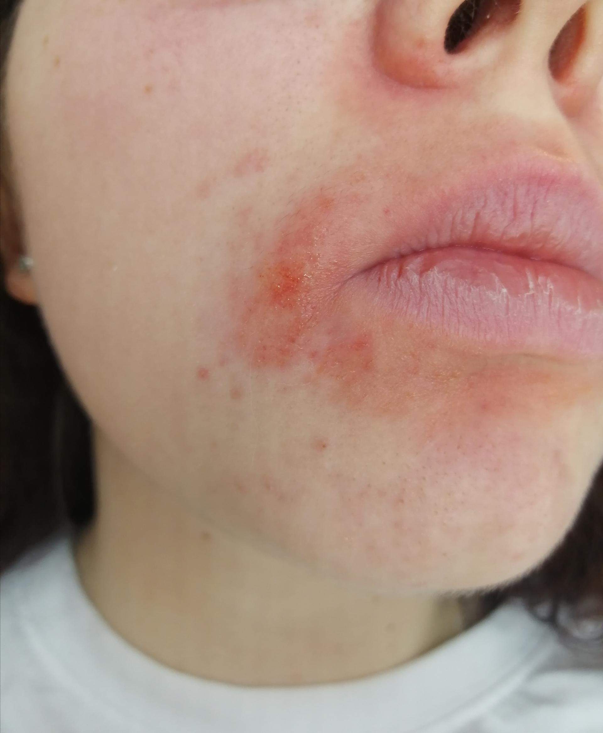 Ist das ein Ausschlag am Mund? (Haut)