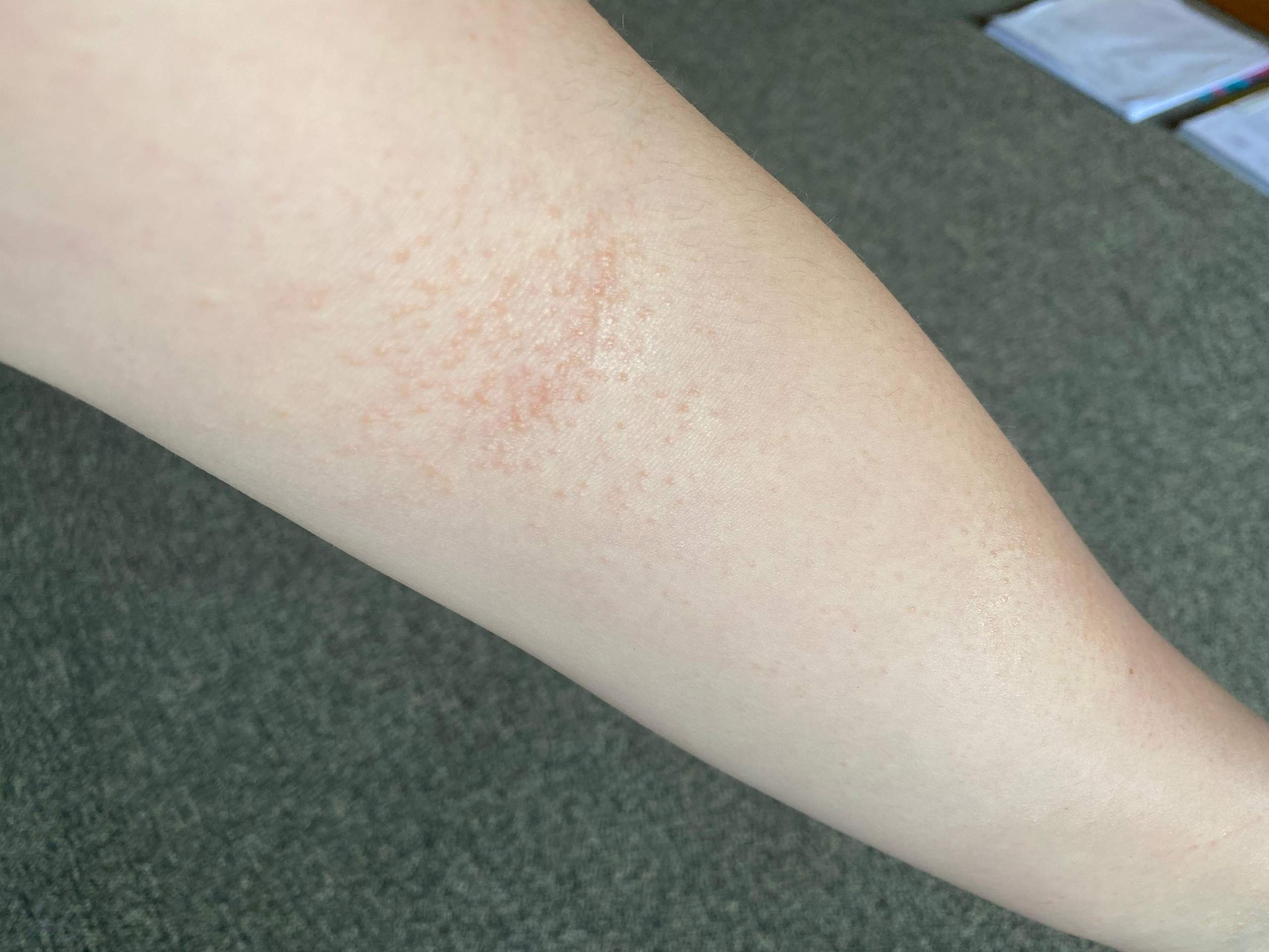 Ist das ein Ausschlag?Allergie?Neurodermitis? (Gesundheit und Medizin