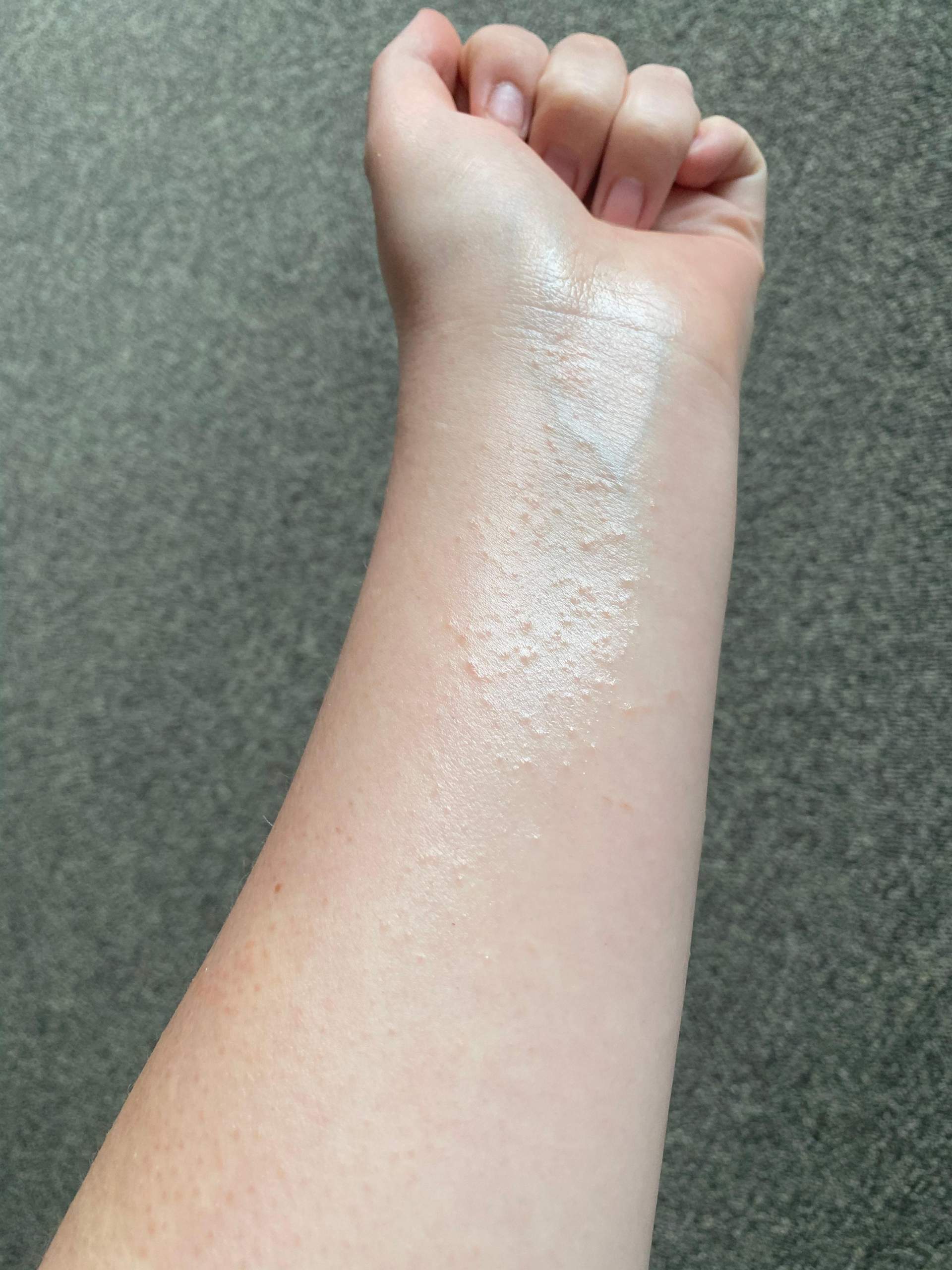 Ist das ein Ausschlag?Allergie?Neurodermitis? (Gesundheit und Medizin