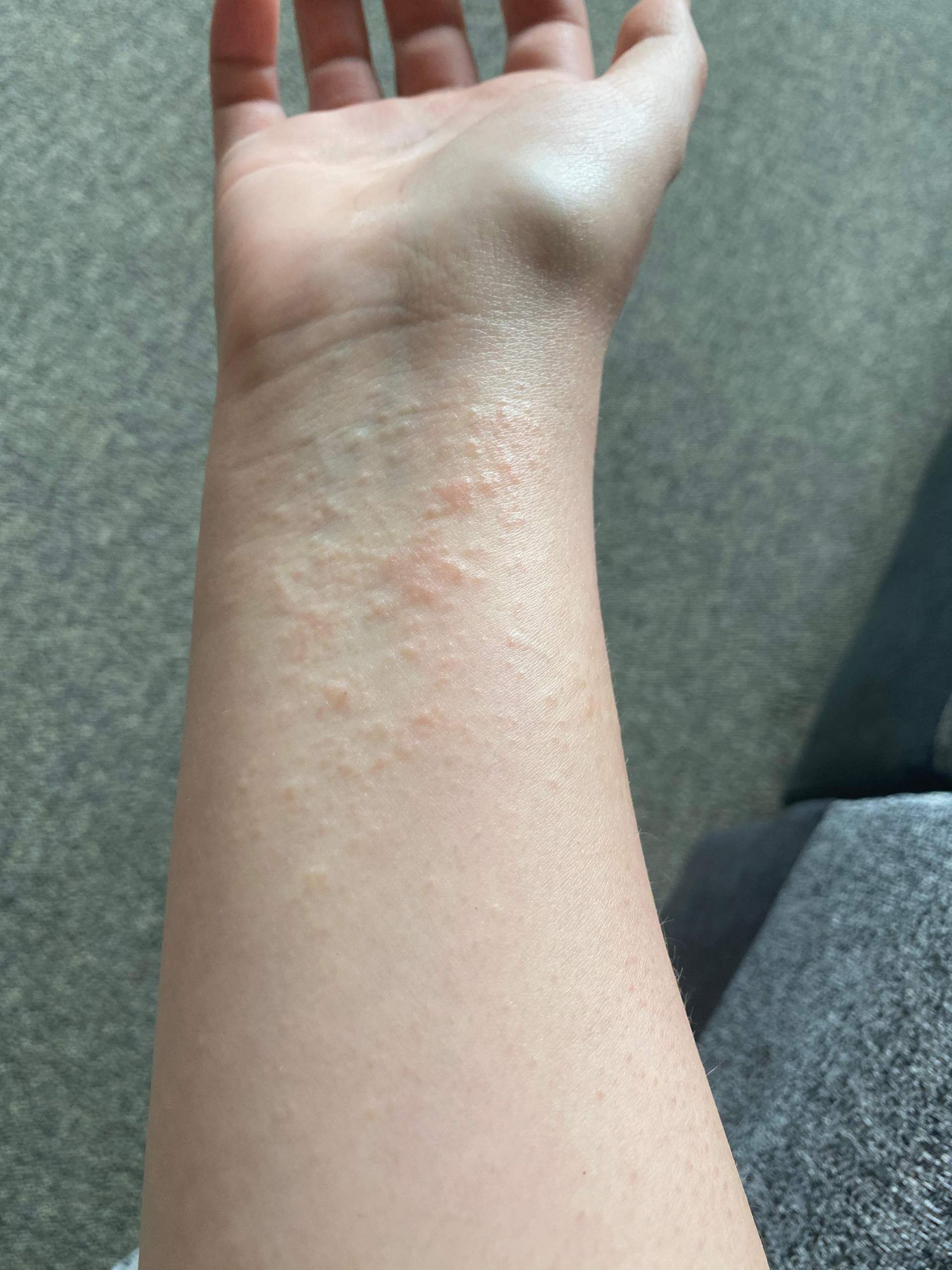 Ist das ein Ausschlag?Allergie?Neurodermitis? (Gesundheit und Medizin