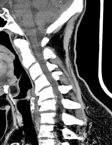 Ist Das Ein Bandscheibenvorfall Ct Schule Gesundheit Und Medizin Gesundheit Ist Das Ein Bandscheibenvorfall Ct Schule Gesundheit Und Medizin Gesundheit