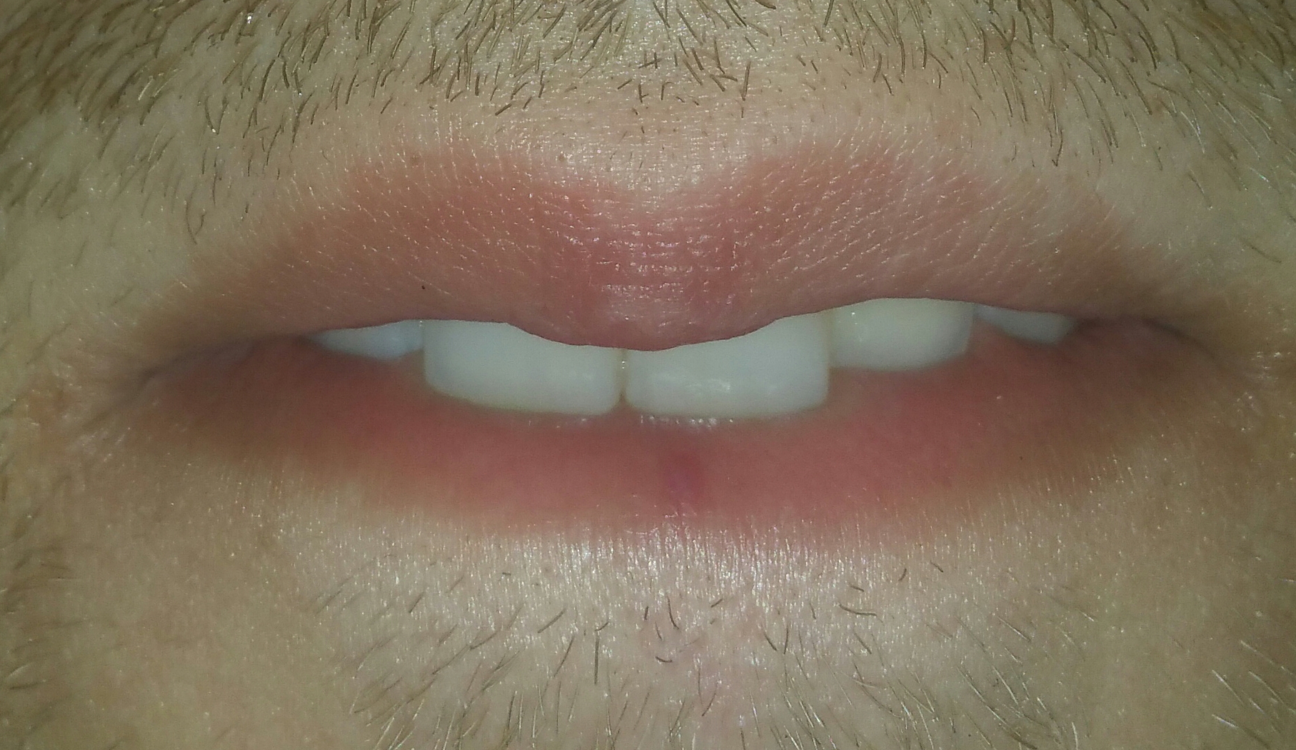 Ist das ein Bluterguss? Wie kann ich den entfernen lassen, er geht seit