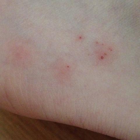 Flohe Bild Flohbiss Der Nicht Juckt Flohe Bild Flohbiss Der Nicht Juckt