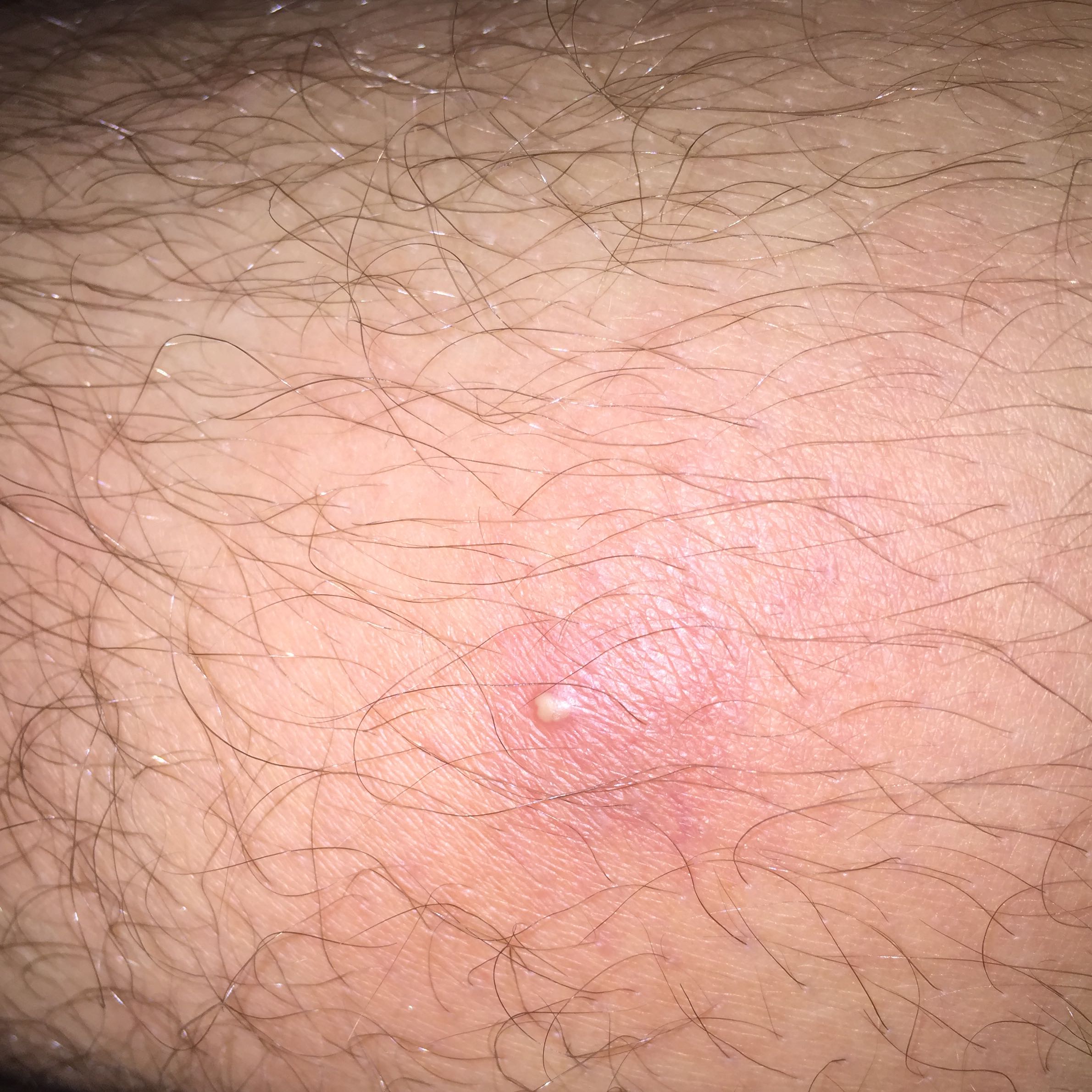 Ist das ein Furunkel oder ein pickel? (Gesundheit und Medizin, Medizin Ist das ein Furunkel oder ein pickel? (Gesundheit und Medizin, Medizin