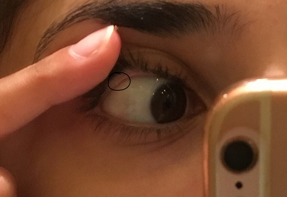 Ist Das Ein Gerstenkorn An Meinem Auge Gesundheit Und Medizin Augen Ist Das Ein Gerstenkorn An Meinem Auge Gesundheit Und Medizin Augen