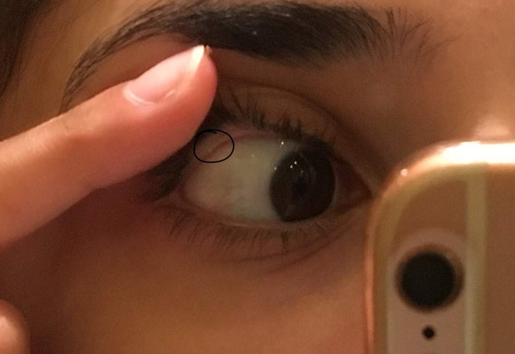 Ist Das Ein Gerstenkorn An Meinem Auge Gesundheit Und Medizin Augen Ist Das Ein Gerstenkorn An Meinem Auge Gesundheit Und Medizin Augen