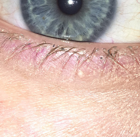 - (Augen, Gerstenkorn)