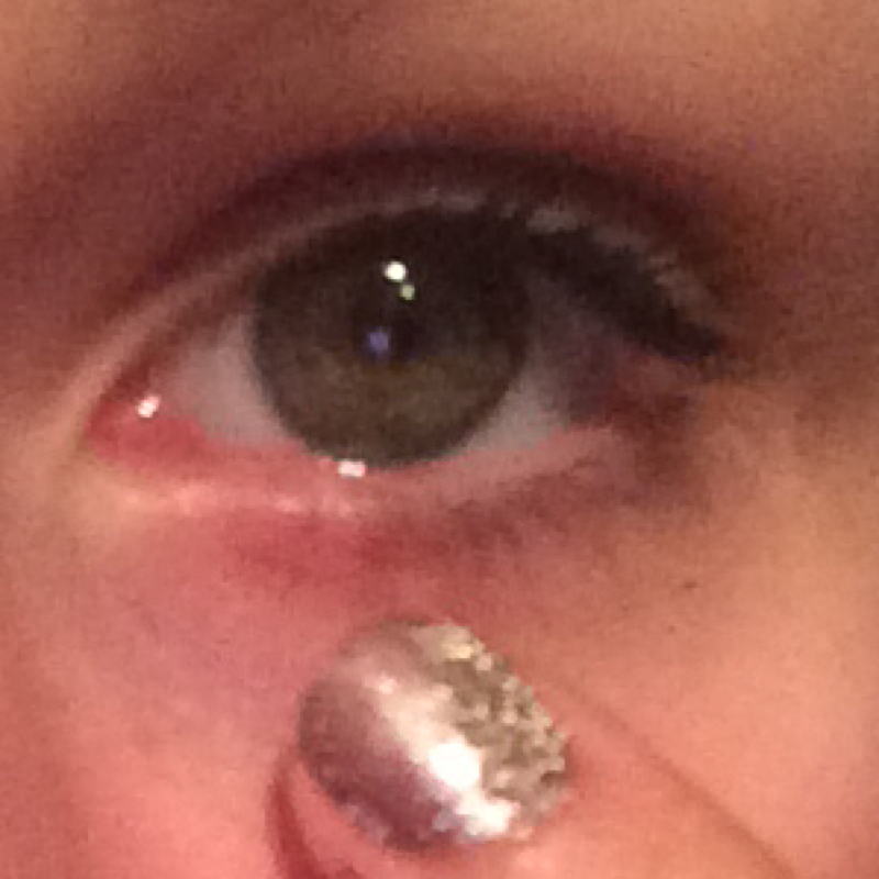 Papst franziskus Ist das ein Gerstenkorn/grieskorn? (Gesundheit, Arzt, Schmerzen)