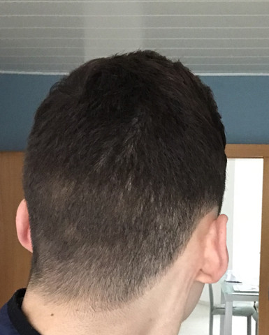 haarwirbel oder haarausfall haare