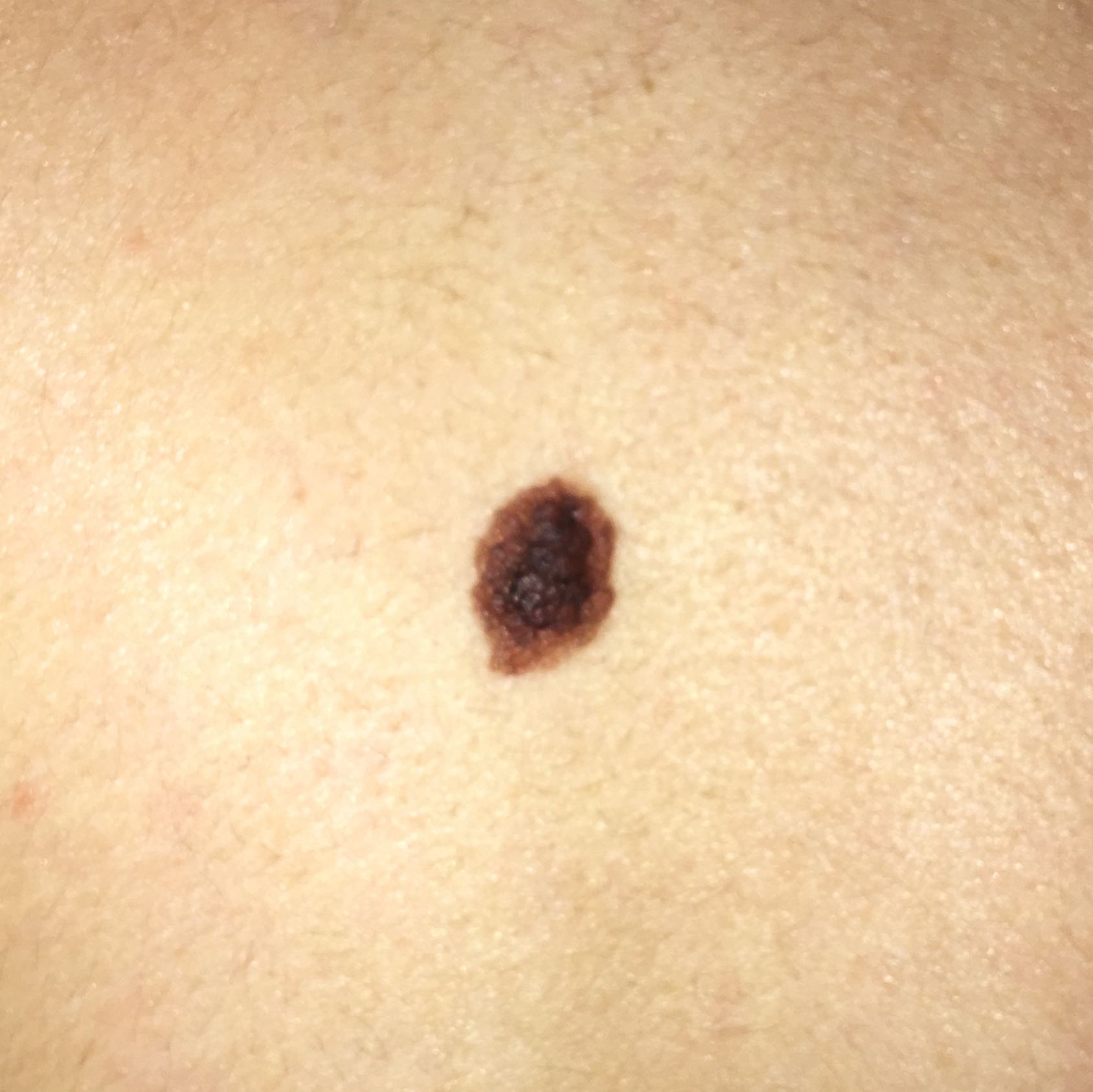 Ist das ein Hautkrebs oder ein Muttermal?