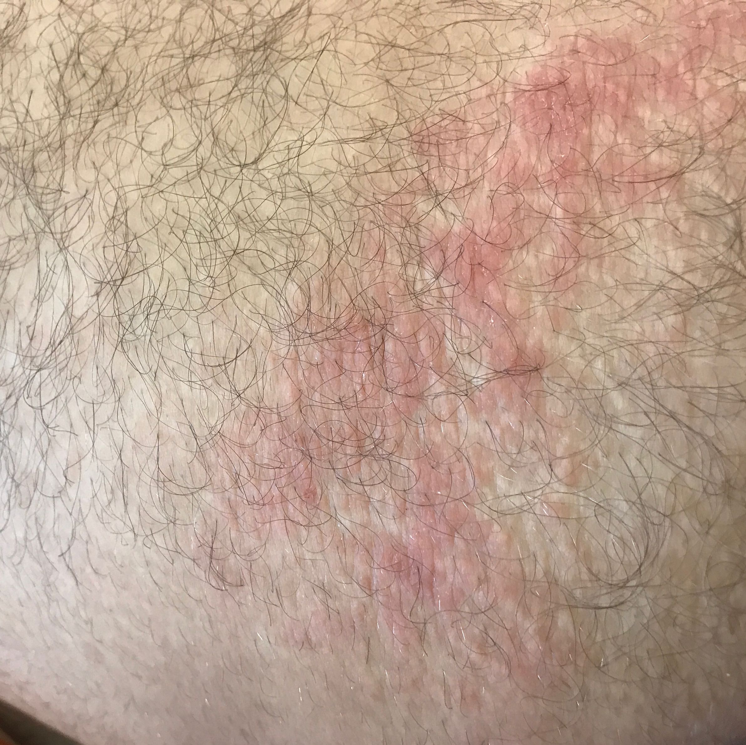 Ist das ein Hautpilz an meinem Oberschenkel? (Gesundheit und Medizin, Medizin, Arzt)