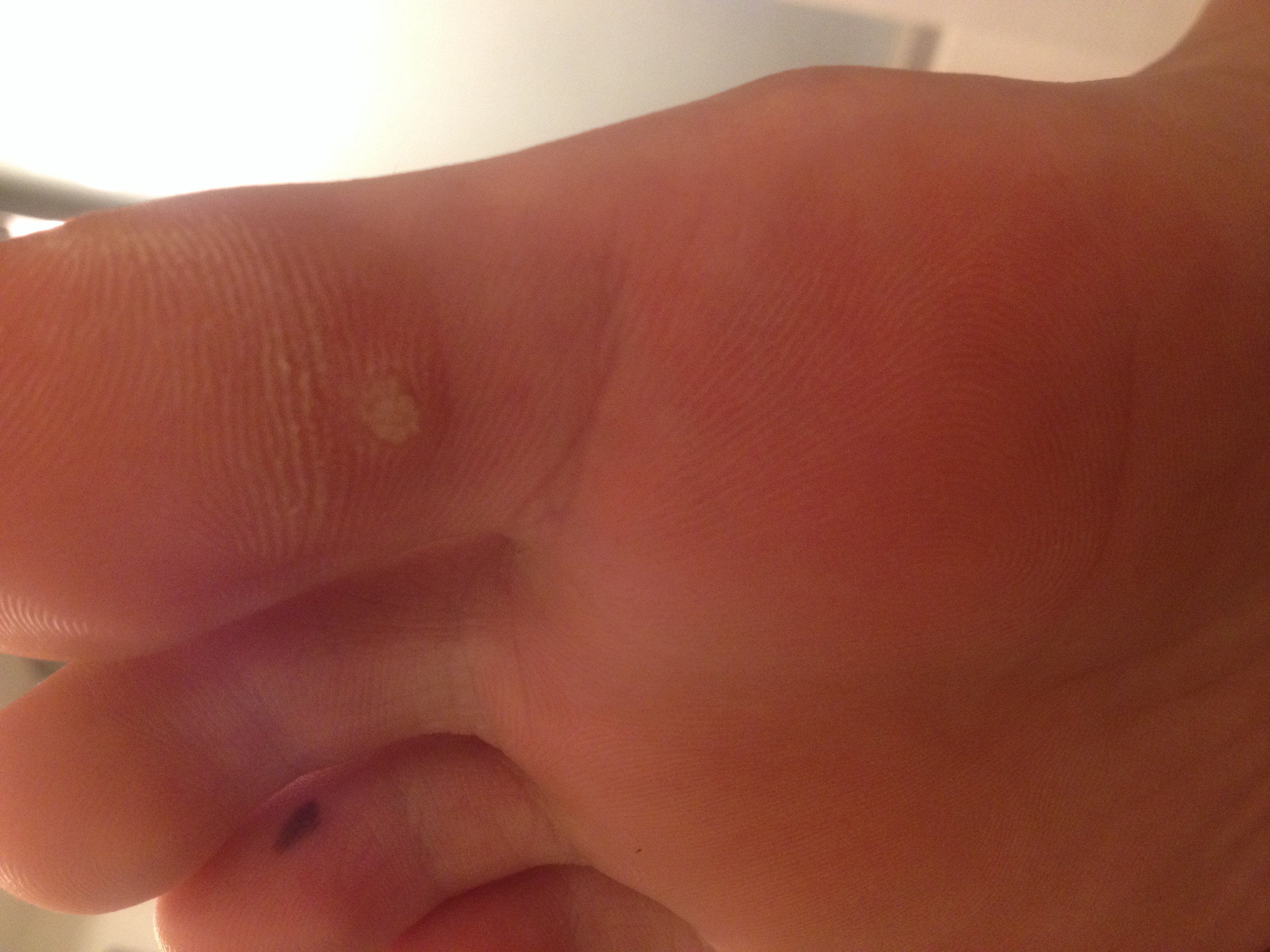 Ist das ein Hühnerauge oder eine Warze am Fuß?(Siehe Bild in der Ist das ein Hühnerauge oder eine Warze am Fuß?(Siehe Bild in der