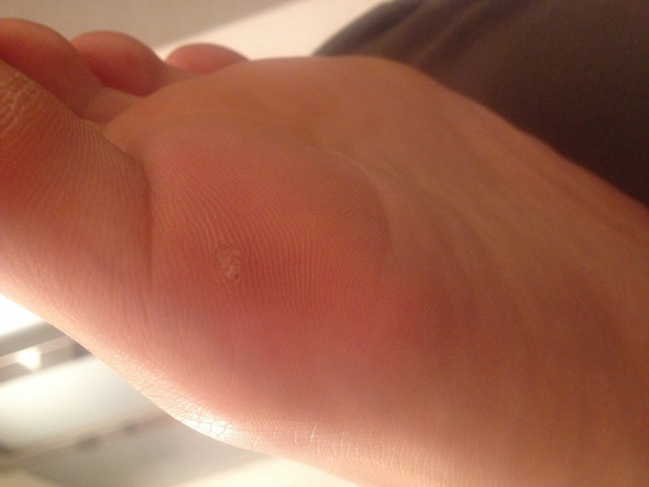 Ist Das Ein Huhnerauge Oder Eine Warze Am Fuss Siehe Bild In Der Beschreibung Gesundheit Pflege Fusse Ist Das Ein Huhnerauge Oder Eine Warze Am Fuss Siehe Bild In Der Beschreibung Gesundheit Pflege Fusse