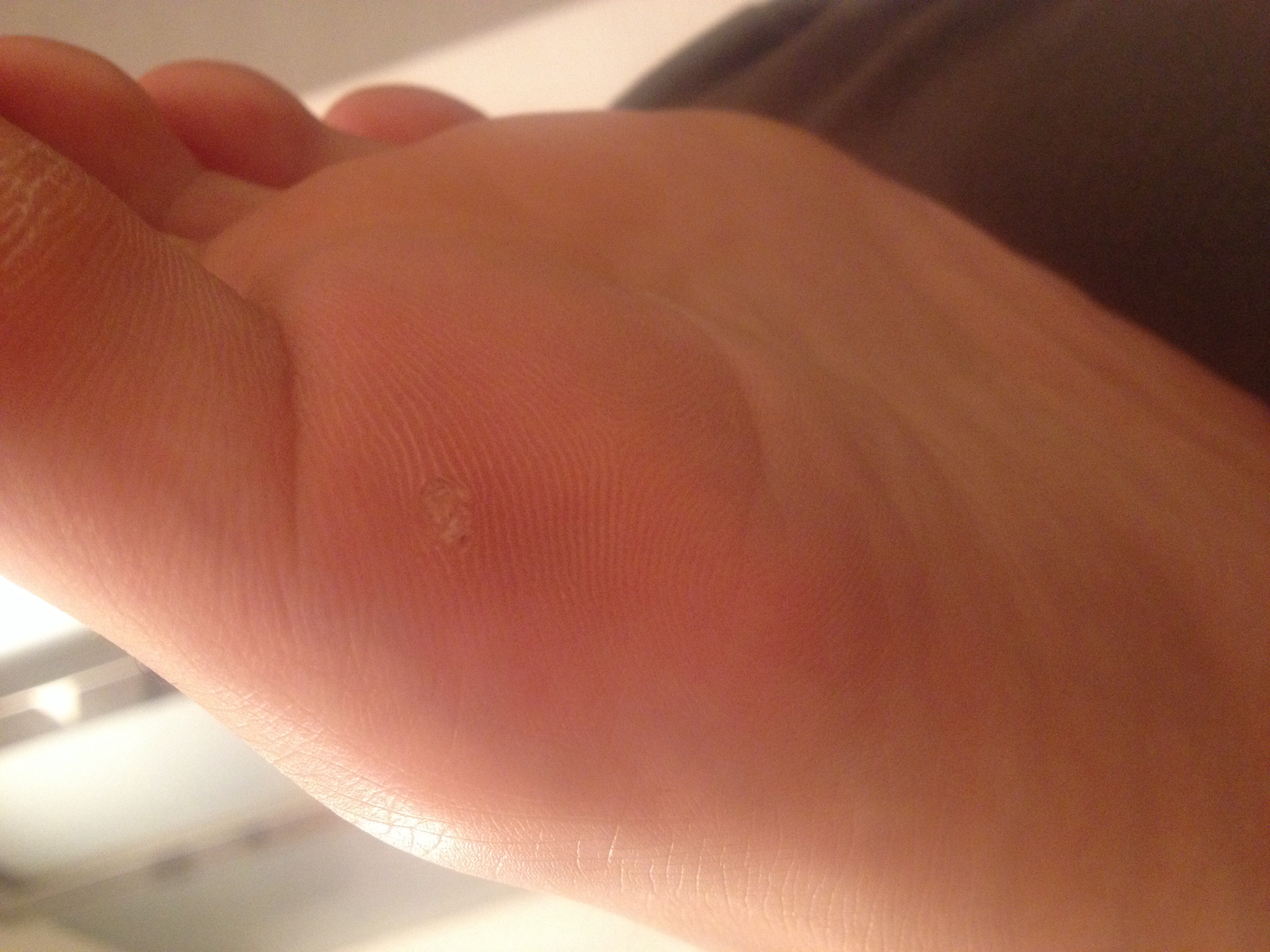 Ist das ein Hühnerauge oder eine Warze am Fuß?(Siehe Bild in der Ist das ein Hühnerauge oder eine Warze am Fuß?(Siehe Bild in der