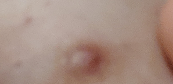 Ist Das Ein Knoten Oder Knubbel Gesundheit Und Medizin Gesundheit Bruste Ist Das Ein Knoten Oder Knubbel Gesundheit Und Medizin Gesundheit Bruste