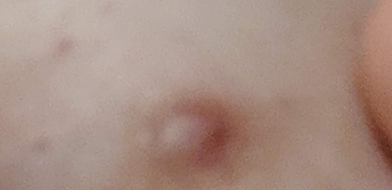 Schamlippe Schmerzender Knoten Schamlippe Schmerzender Knoten