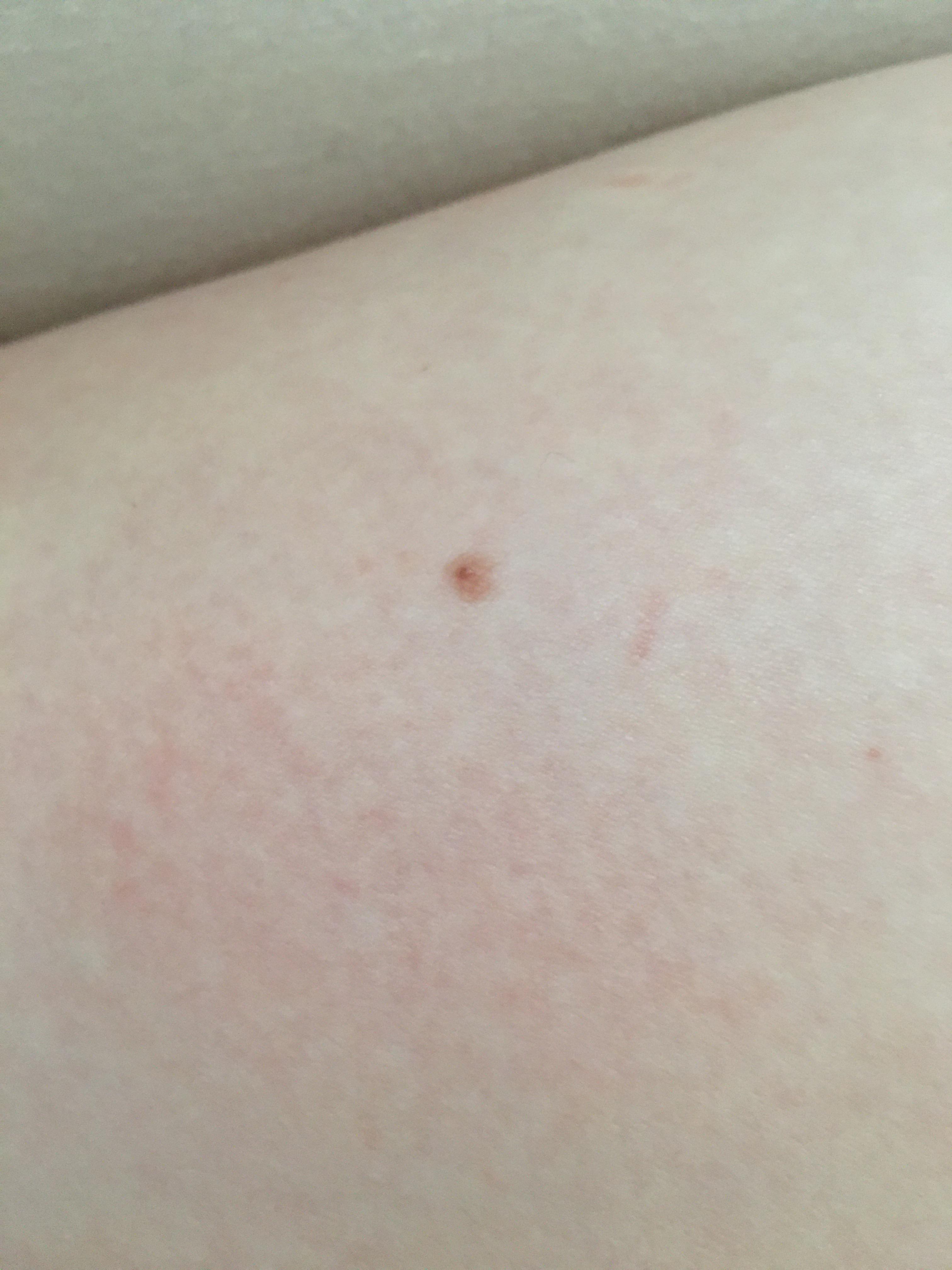 Ist das ein Melanom (schwarzer Hautkrebs)?Bitte um schnelle Antworten