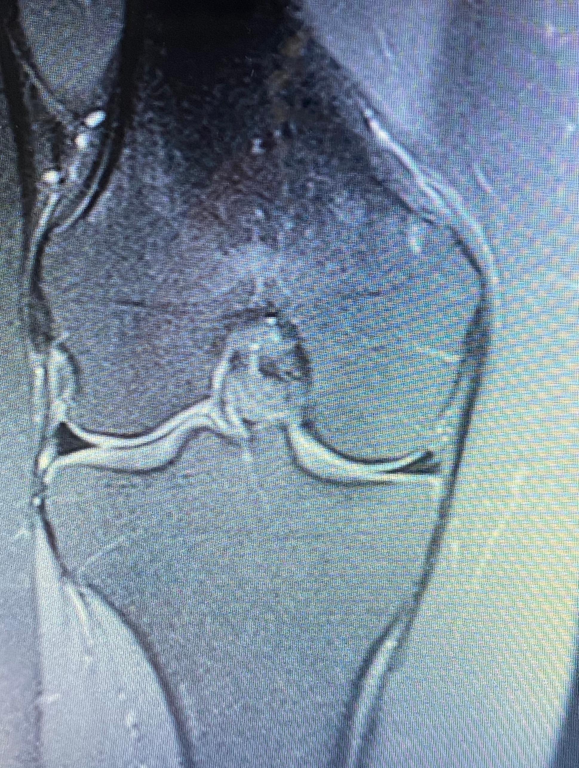 32+ Mrt bilder knie meniskusschaden , Ist das ein Meniskusriss? Knie, MRT)