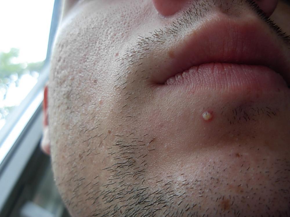 Get Pickel Unter Der Haut Wange Background