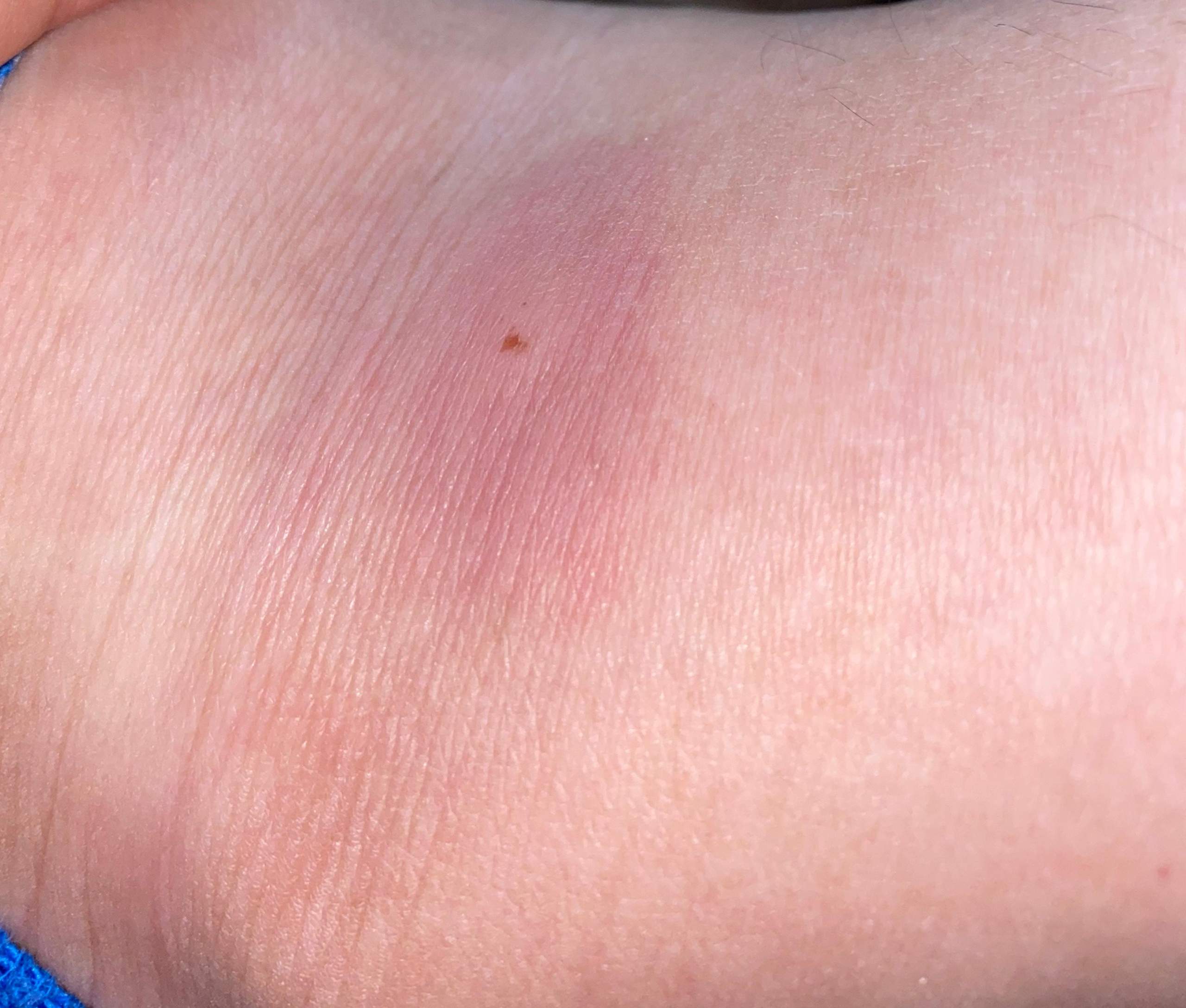 Ist das ein Mückenstich oder was anderes? (Gesundheit und Medizin)