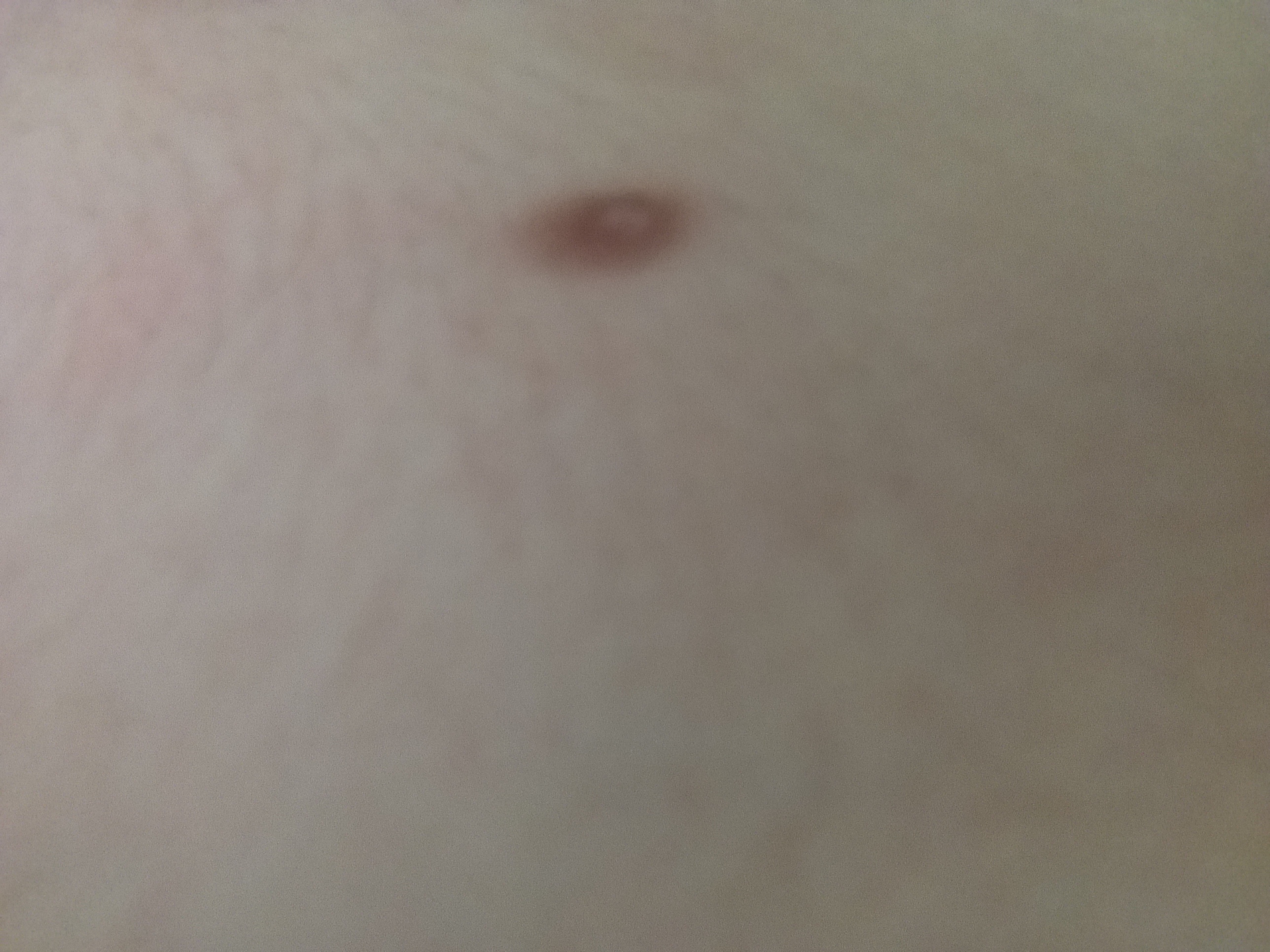 Ist Das Ein Muttermal Oder Eine Dritte Brustwarze Gesundheit Korper Ist Das Ein Muttermal Oder Eine Dritte Brustwarze Gesundheit Korper