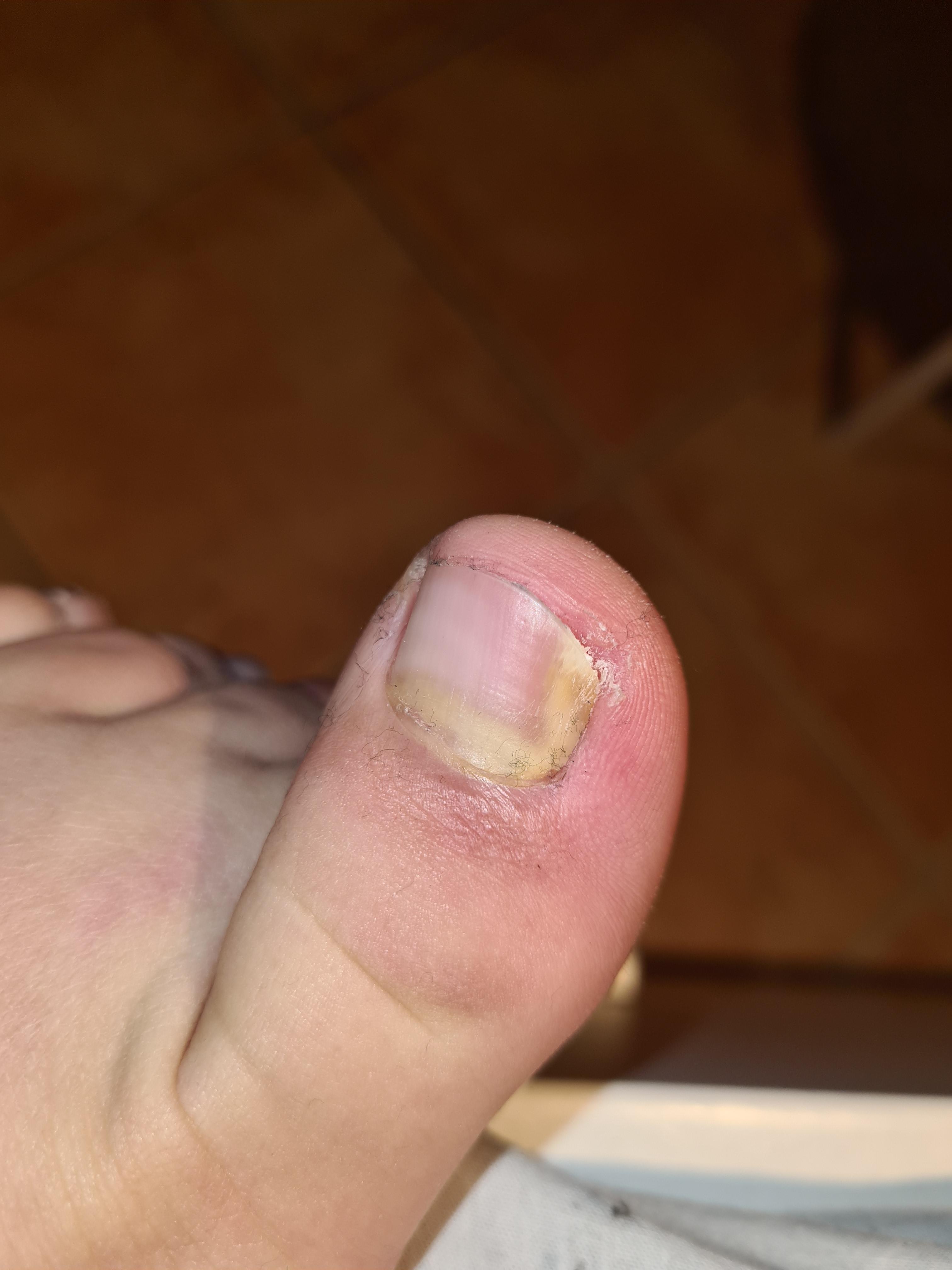 Ist das ein Nagelpilz? (Gesundheit und Medizin, Gesundheit, Füße)