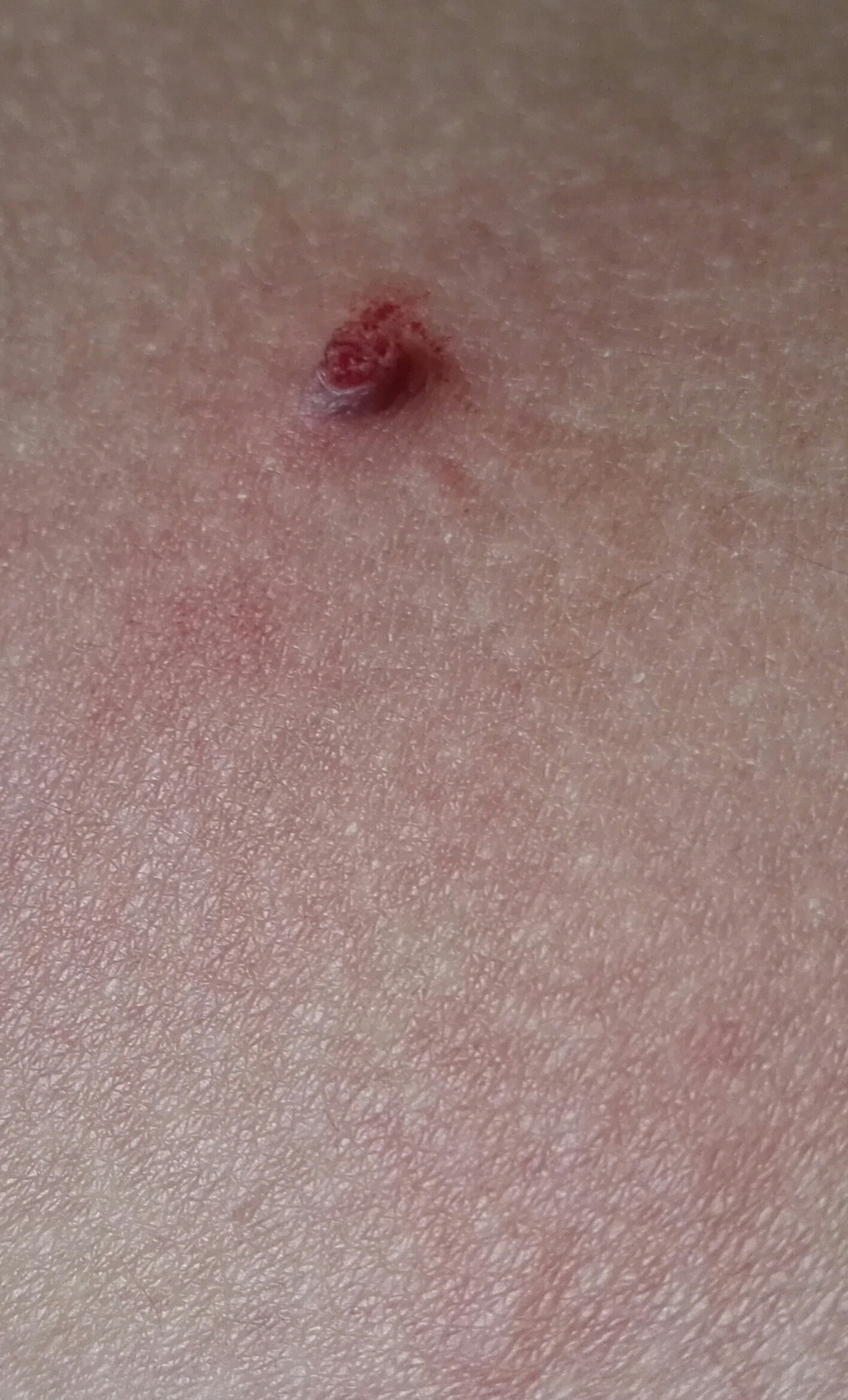 Ist das ein normaler Pickel oder was ist das?''? (Gesundheit, Haut) pickel auf der haut