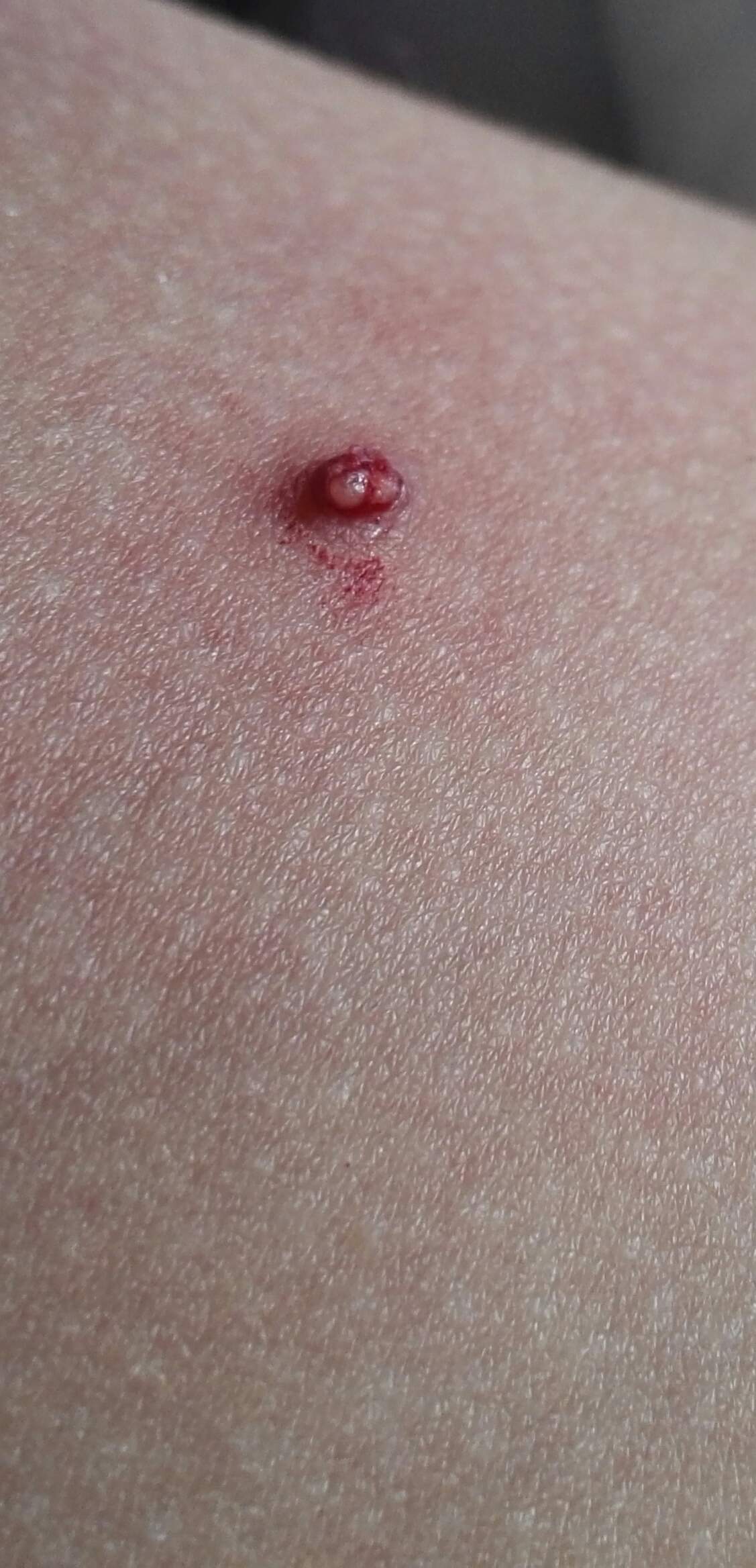 Ist das ein normaler Pickel oder was ist das?''? (Gesundheit, Haut) pickel einnistung