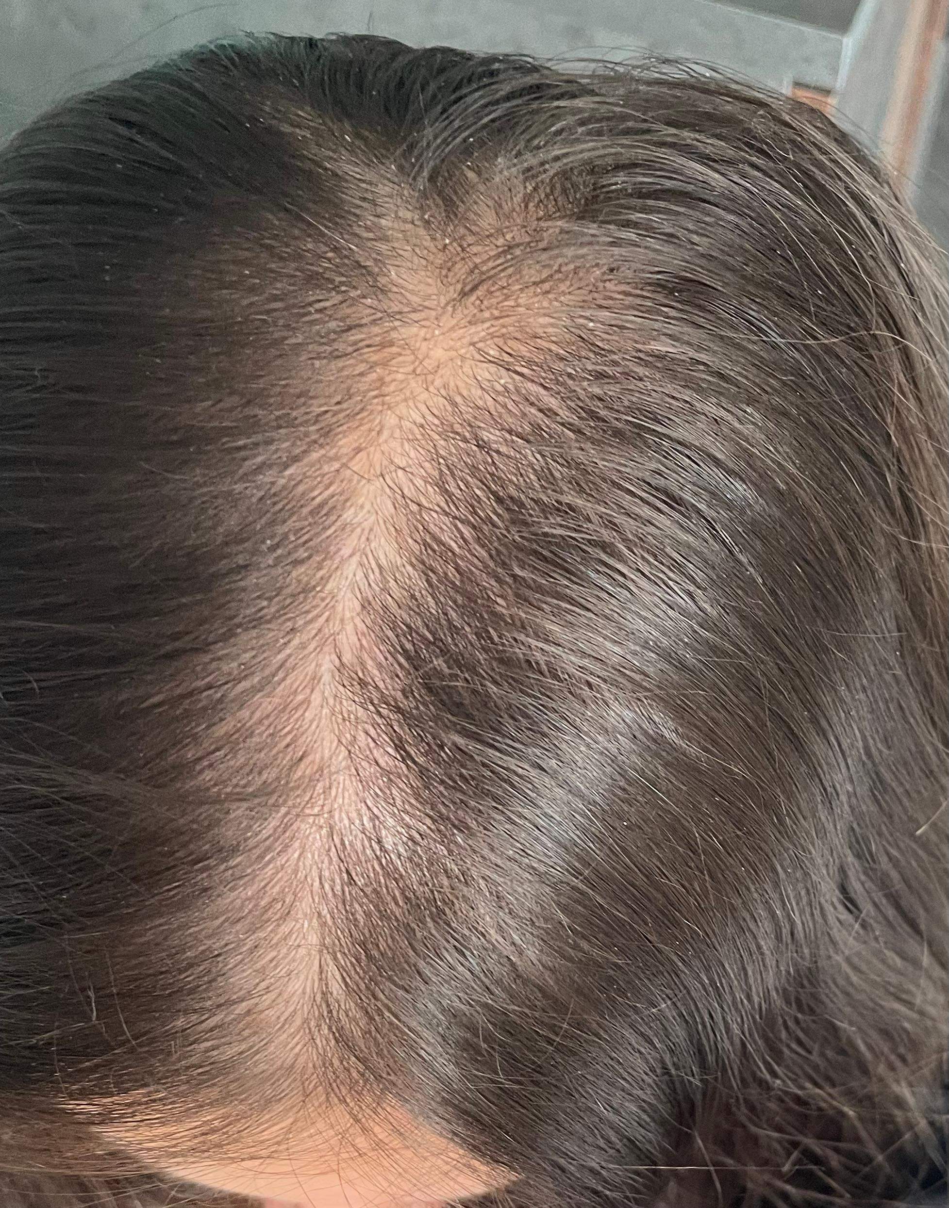 Ist Das Ein Normaler Scheitel Aussehen Haarausfall Ist Das Ein Normaler Scheitel Aussehen Haarausfall