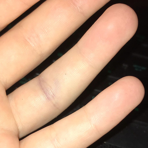Finger verstaucht wie lange geschwollen