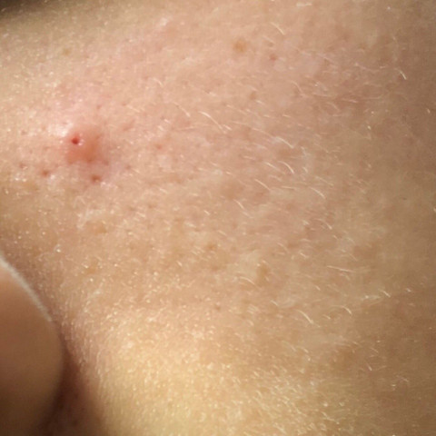 eingewachsenes haar poren