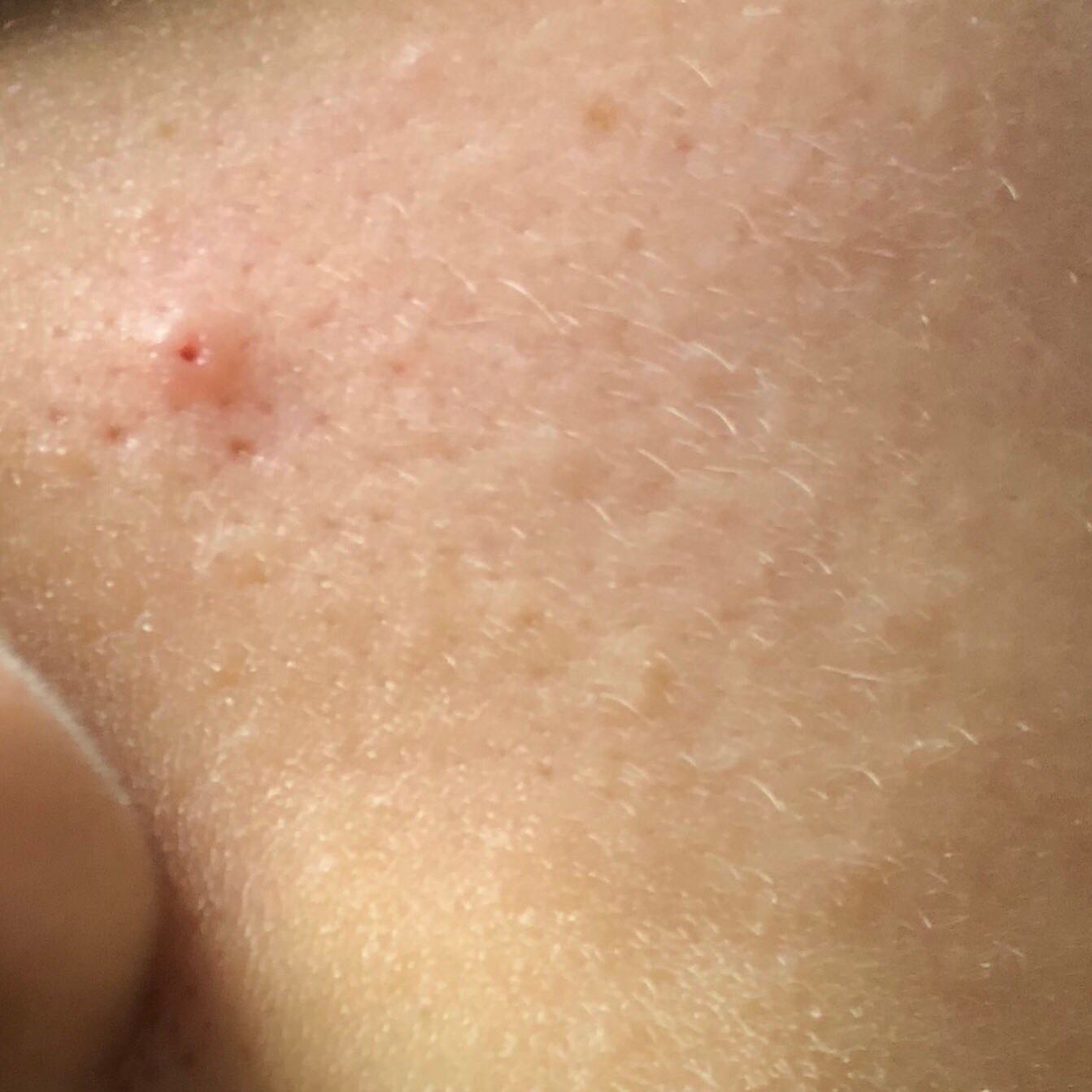 eingewachsenes haar poren