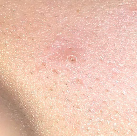 eingewachsenes haar poren