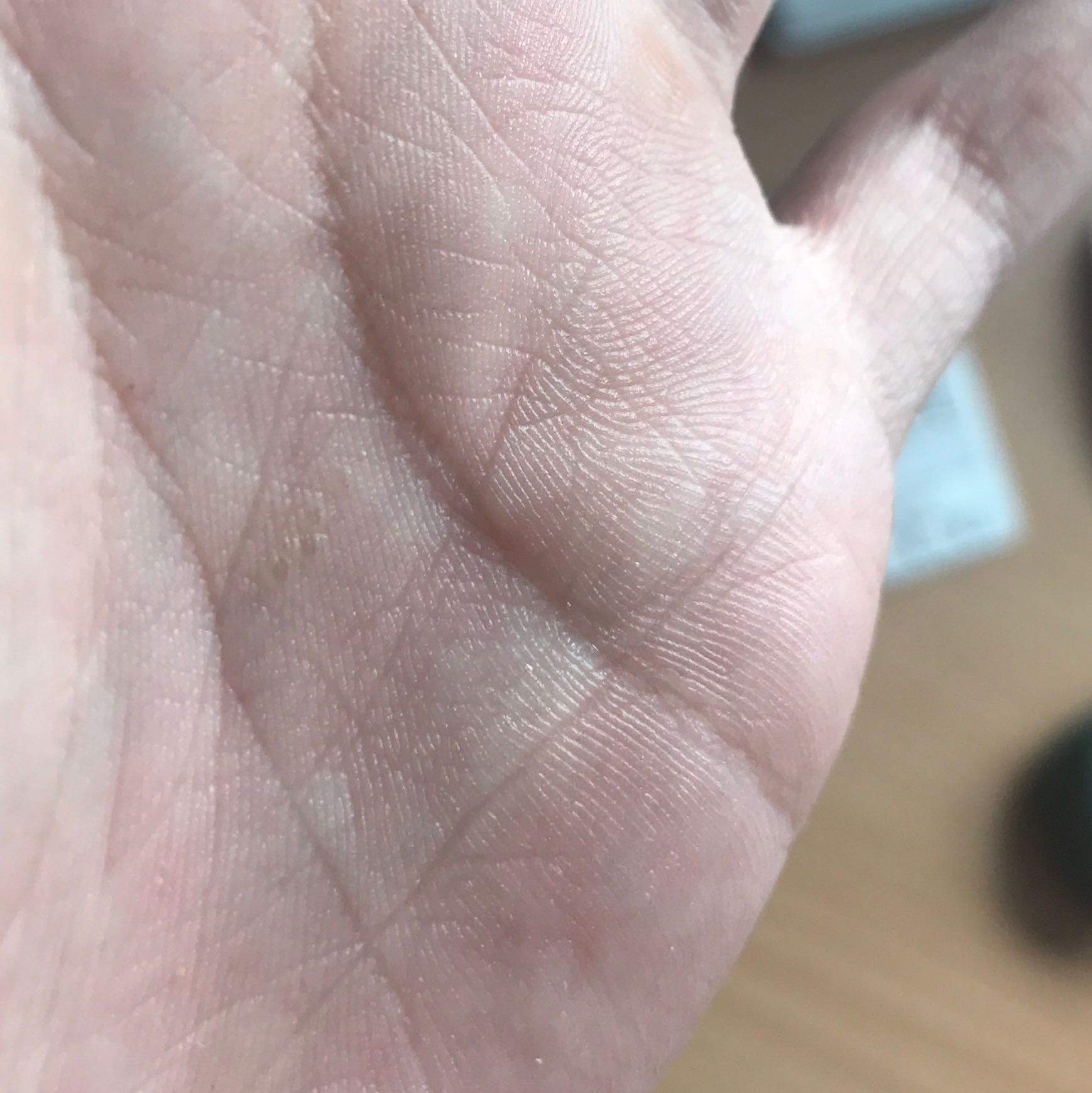 Ist das ein Pilz an der Handinnenfläche? (Gesundheit, Medizin, Krankheit) Ist das ein Pilz an der Handinnenfläche? (Gesundheit, Medizin, Krankheit)