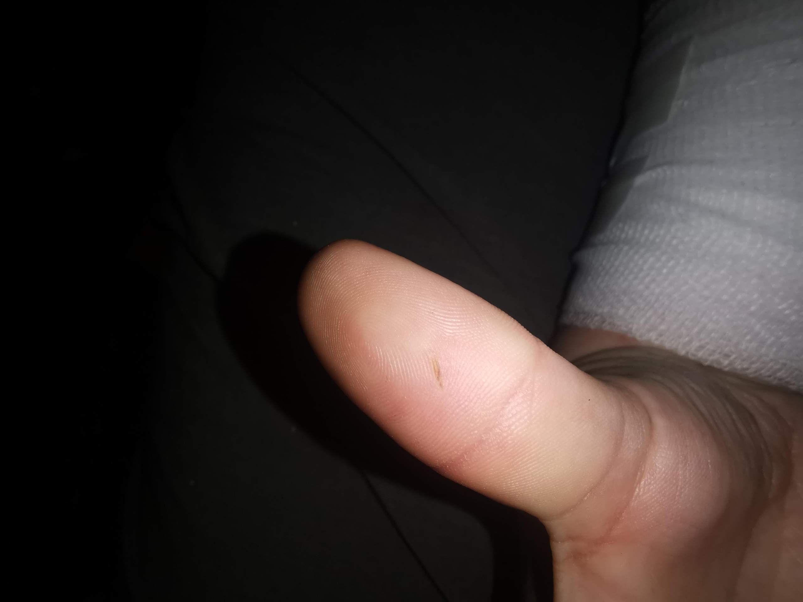 Ist das ein Rest von einem splitter oder nur blut das sich unter der
