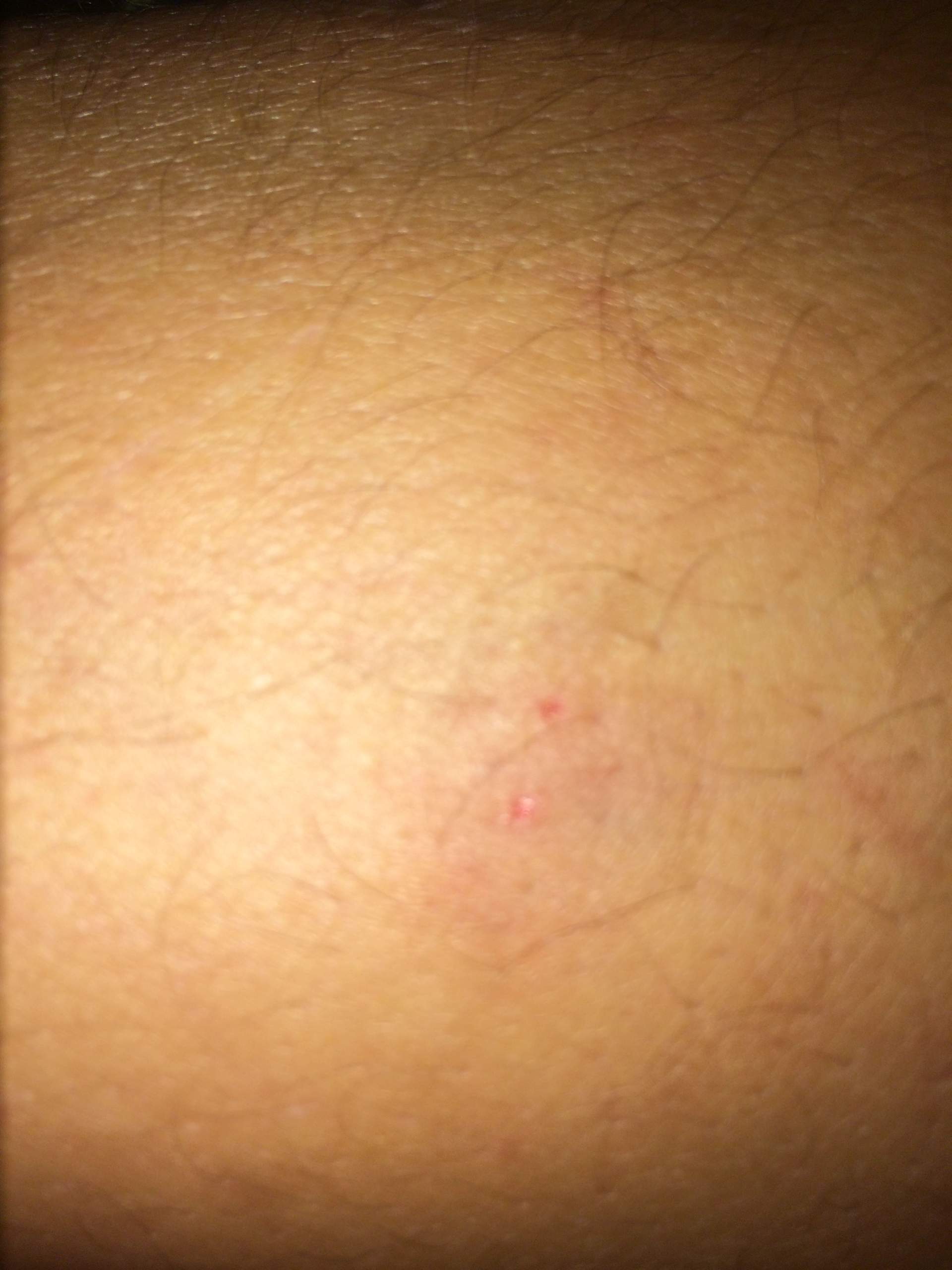 Ist Das Ein Schlangenbiss Insekten Ist Das Ein Schlangenbiss Insekten