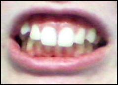 meine zähne - (Zähne, Zahnspange)