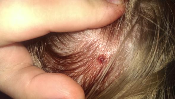Ist Das Ein Zecken Biss Eine Blutblase Oder Sonst Was Pickel Blut Kopfhaut