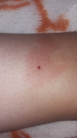 Ist Das Ein Zeckenbiss Bild Biss Zecke