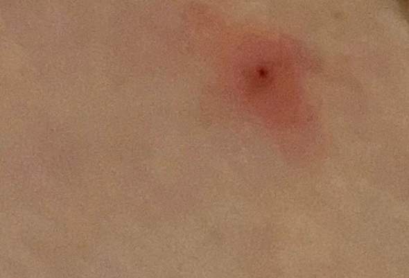 Ist Das Ein Zeckenbiss Gewesen Sommer Pool Zecken Ist Das Ein Zeckenbiss Gewesen Sommer Pool Zecken