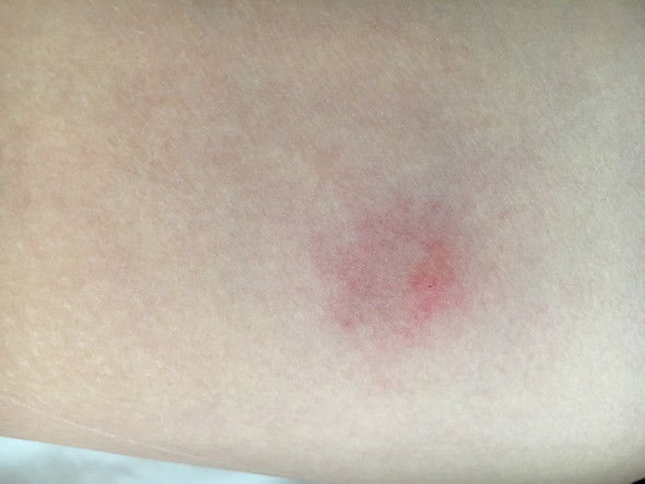Ist Das Ein Zeckenbiss Oder Borreliose Arzt Ist Das Ein Zeckenbiss Oder Borreliose Arzt
