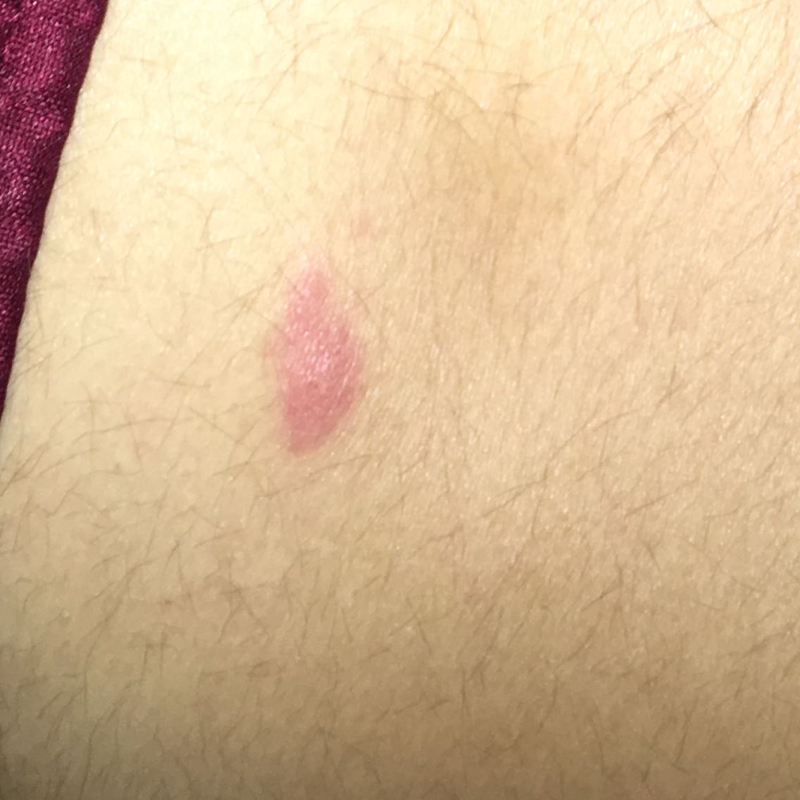 Ist das ein Zeckenbiss .x (? (Rötung, Insektenstich) Ist das ein Zeckenbiss .x (? (Rötung, Insektenstich)