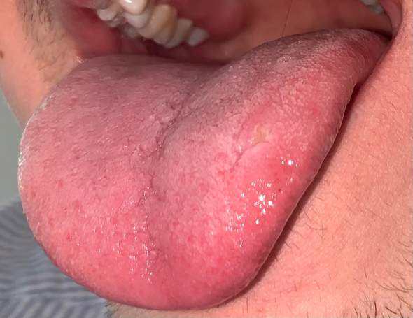 Ist Das Eine Aphte Oder Mehr Gesundheit Und Medizin Mund Ist Das Eine Aphte Oder Mehr Gesundheit Und Medizin Mund